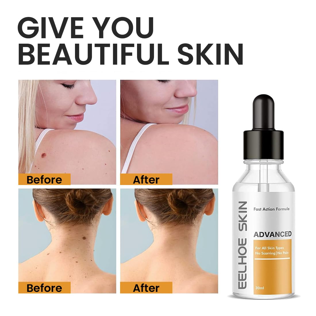 Skin Tag & Mole Remover Serum – Quick-Acting Natural Formula for Face and Body – Simple to Use, 30ML