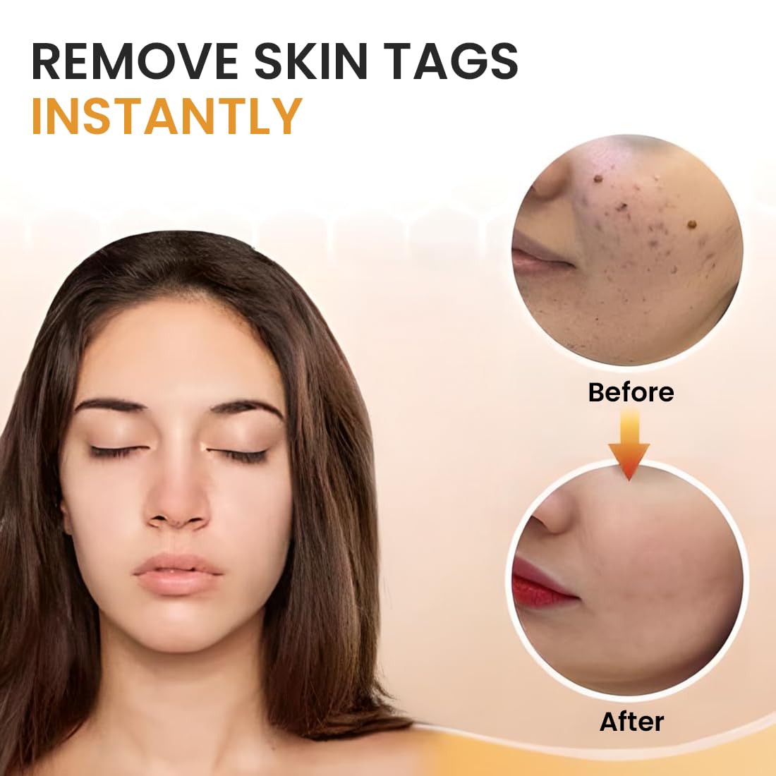 Skin Tag & Mole Remover Serum – Quick-Acting Natural Formula for Face and Body – Simple to Use, 30ML