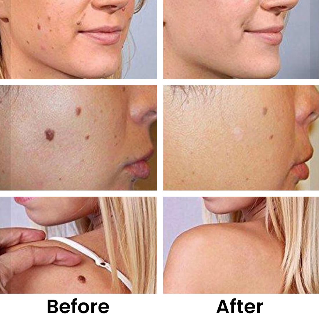 Skin Tag & Mole Remover Serum – Quick-Acting Natural Formula for Face and Body – Simple to Use, 30ML